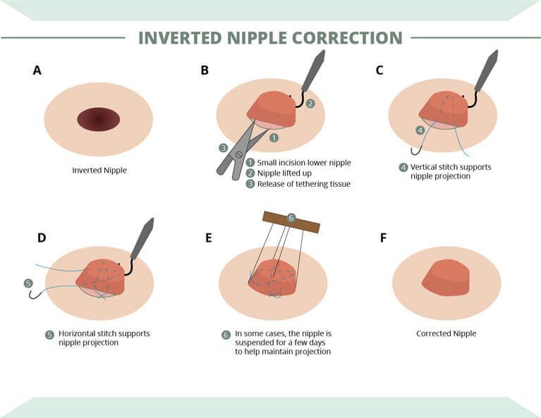 Correct Inverted Nipples - Surgery vs Nonsurgical Methods - Dr. Chen Lee