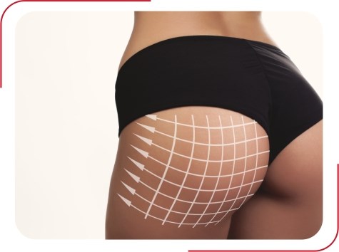 Buttock Lift - Invivo Aesthetics