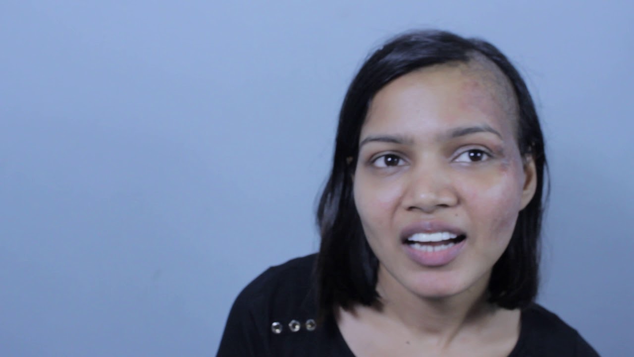 Burn scar treated with Ultrapulse - Payal