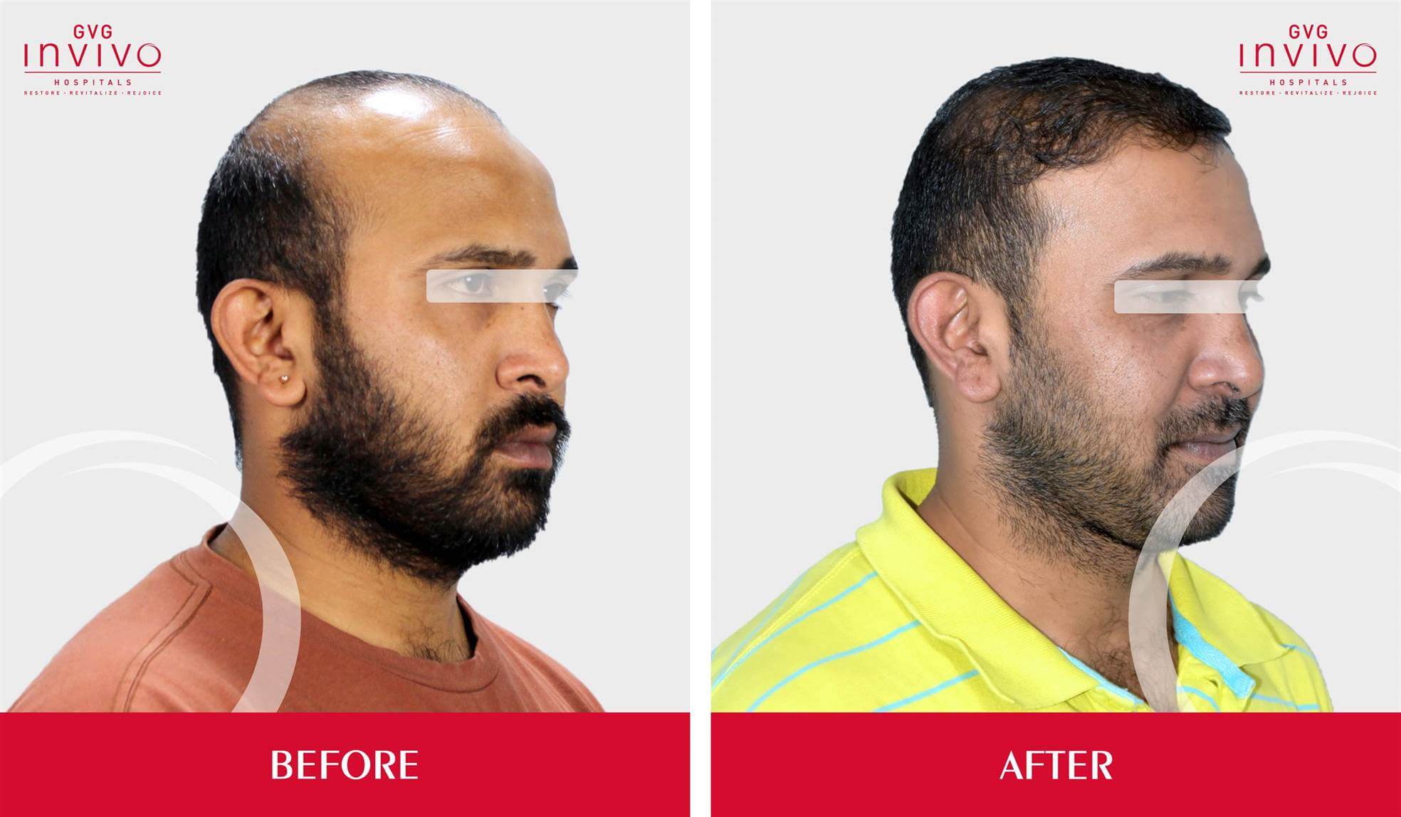 Hair Transplantation in Bangalore – Invivo Aesthetics
